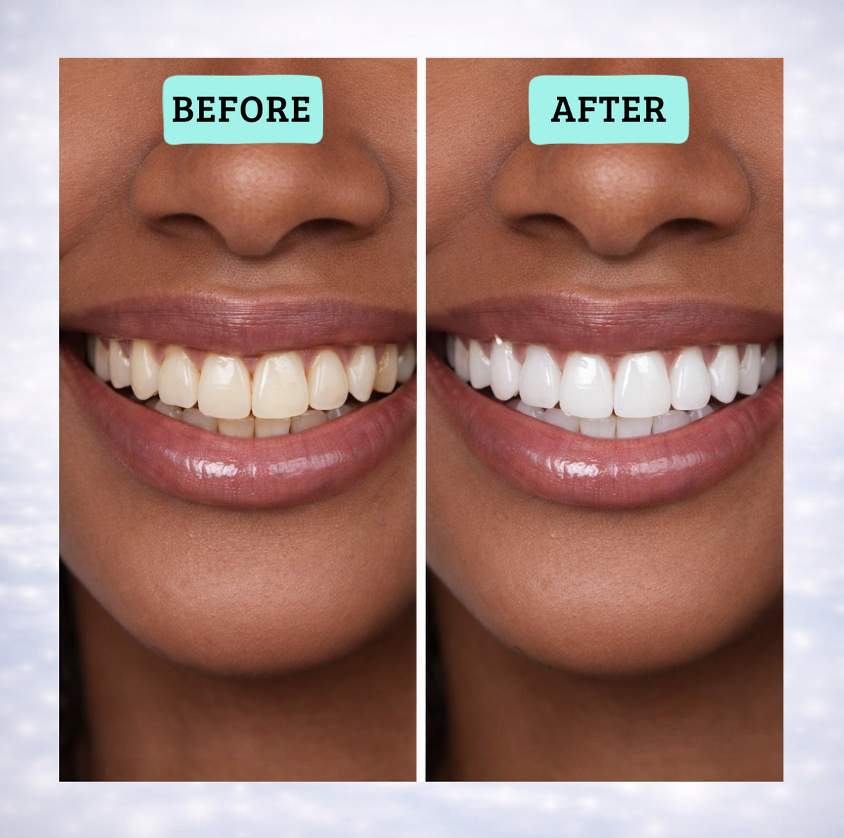 Blancora Exclusive Whitening Strips (7-Day Treatment, 2- Strips per Pack) Safe Strip Technology