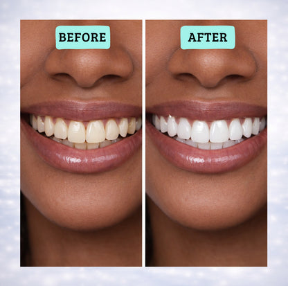 Blancora Exclusive Whitening Strips (7-Day Treatment, 2- Strips per Pack) Safe Strip Technology