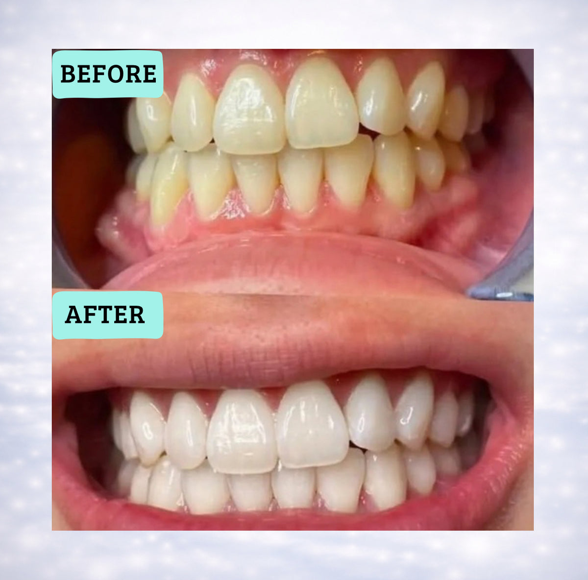 Blancora Exclusive Whitening Strips (7-Day Treatment, 2- Strips per Pack) Safe Strip Technology