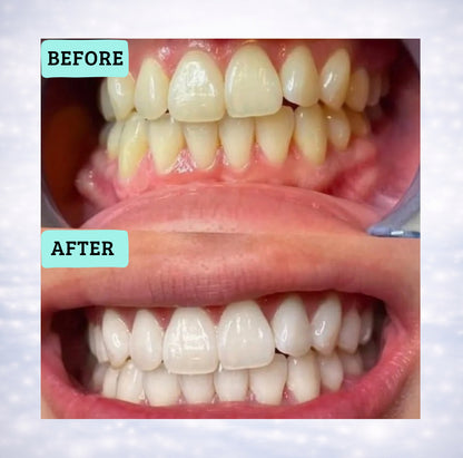 Blancora Exclusive Whitening Strips (7-Day Treatment, 2- Strips per Pack) Safe Strip Technology