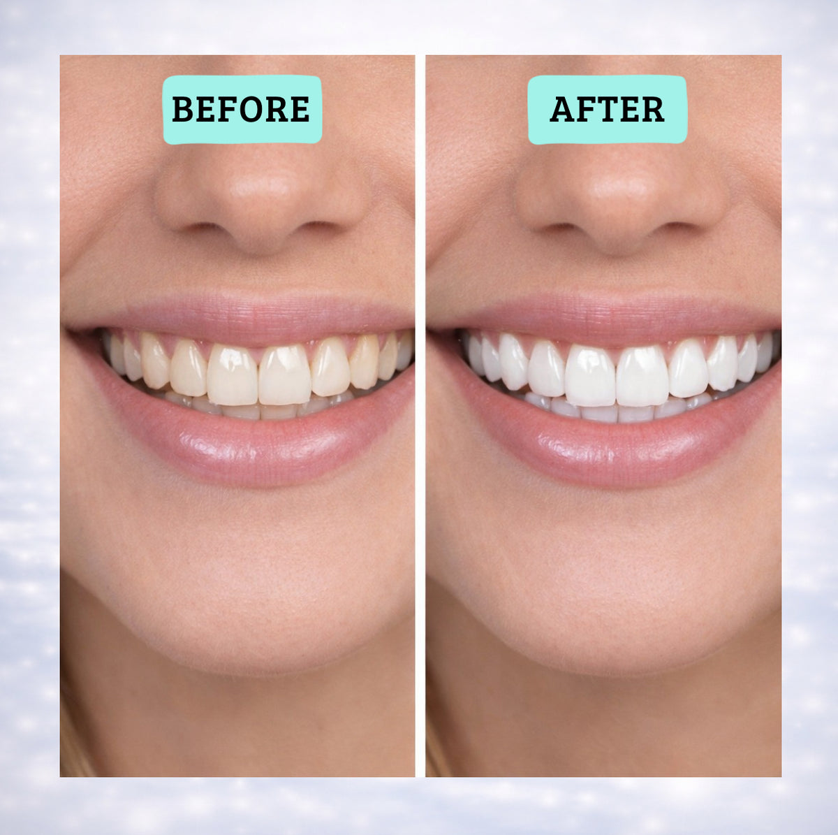 Blancora Exclusive Whitening Strips (7-Day Treatment, 2- Strips per Pack) Safe Strip Technology