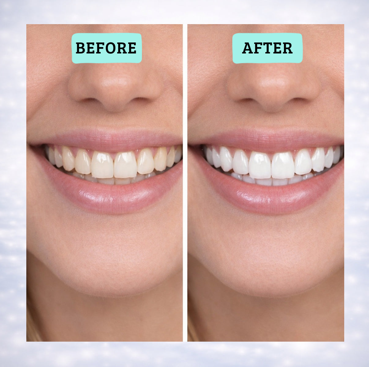 Blancora Exclusive Whitening Strips (7-Day Treatment, 2- Strips per Pack) Safe Strip Technology